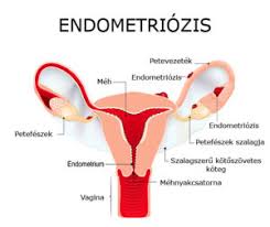 Endometriózis – tények és tévhitek