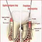 A fogágybetegség ma már nagyobb veszély, mint a fogszuvasodás