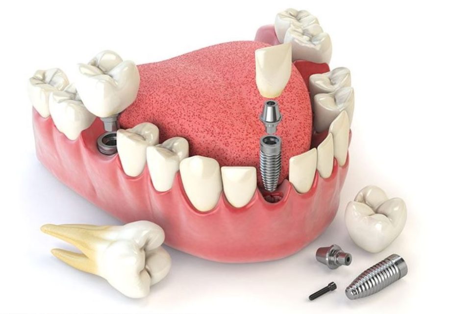implantátum